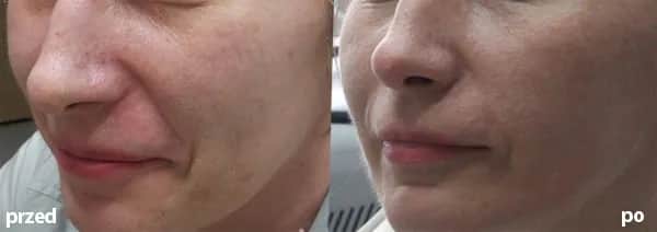 Laser frakcyjny kiedy makijaż - uniknij podrażnień i błędów