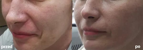 Laser frakcyjny kiedy makijaż - uniknij podrażnień i błędów