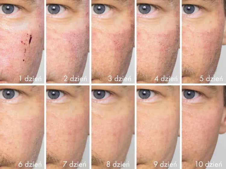 Laser frakcyjny CO2 – co to jest i jak może odmłodzić Twoją skórę