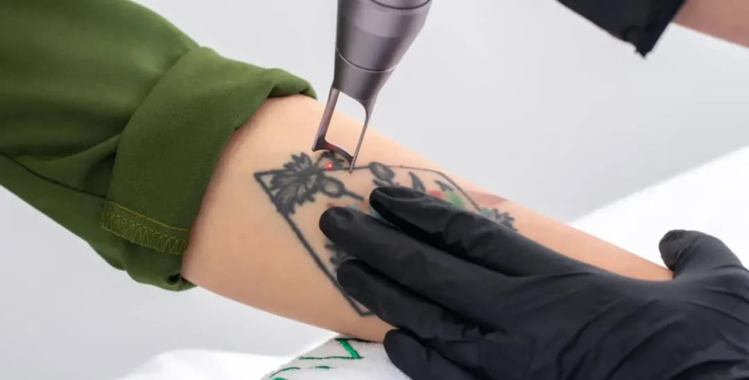 Ile kosztuje usuwanie tatuażu? Sprawdź ceny i czynniki wpływające