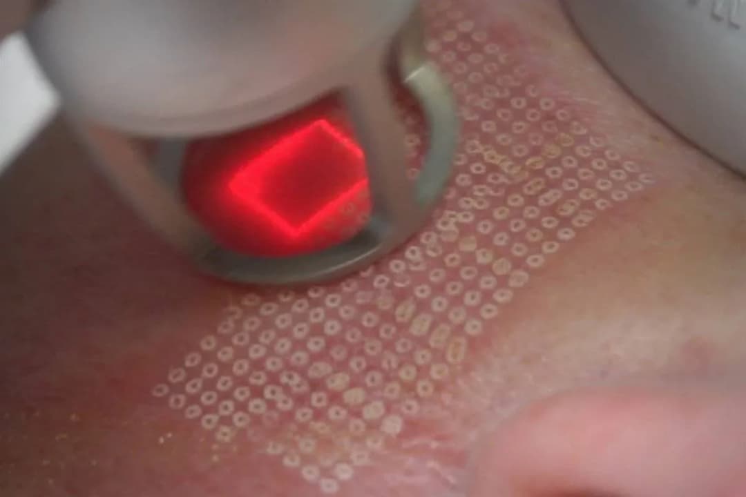 Laser frakcyjny na co pomaga: poznaj jego skuteczne zastosowania